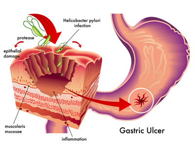 gastric-ulcer